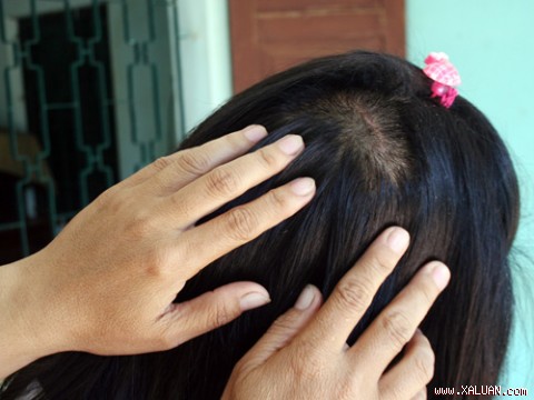Vết thương trên đầu cháu A.T mới lành - Ảnh: Nguyễn Long